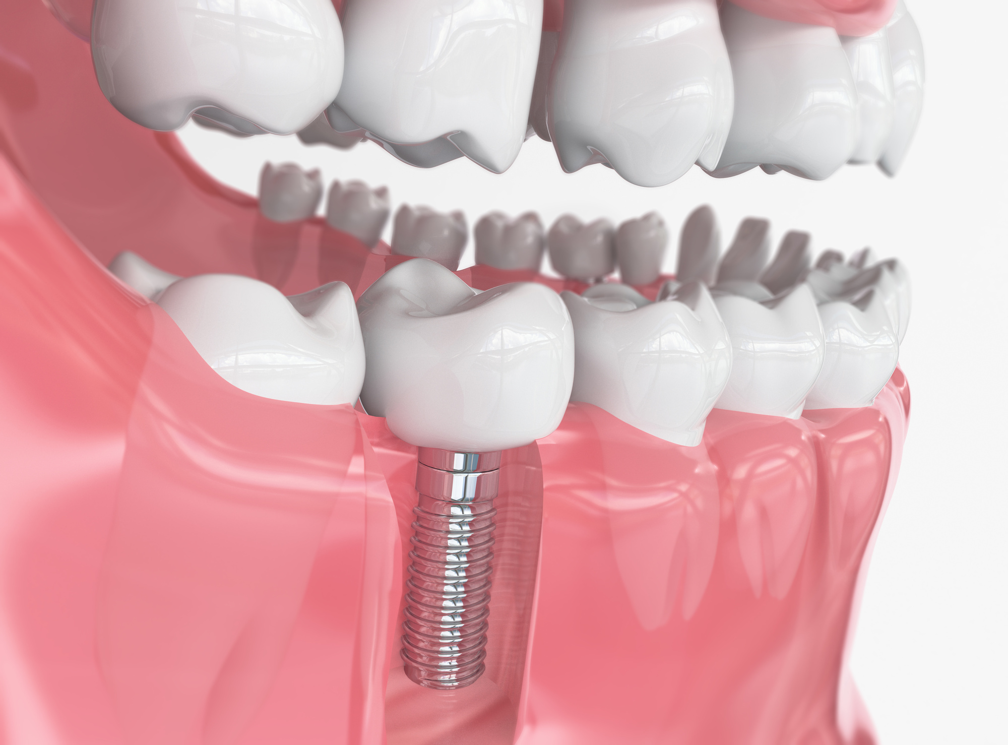 American Dental Assoc # W234