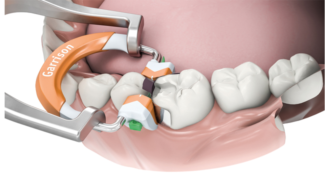 Garrison Dental Solutions # AU100-M