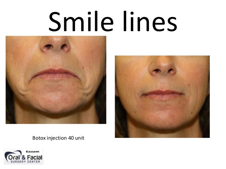 Smile Line USA # 4002